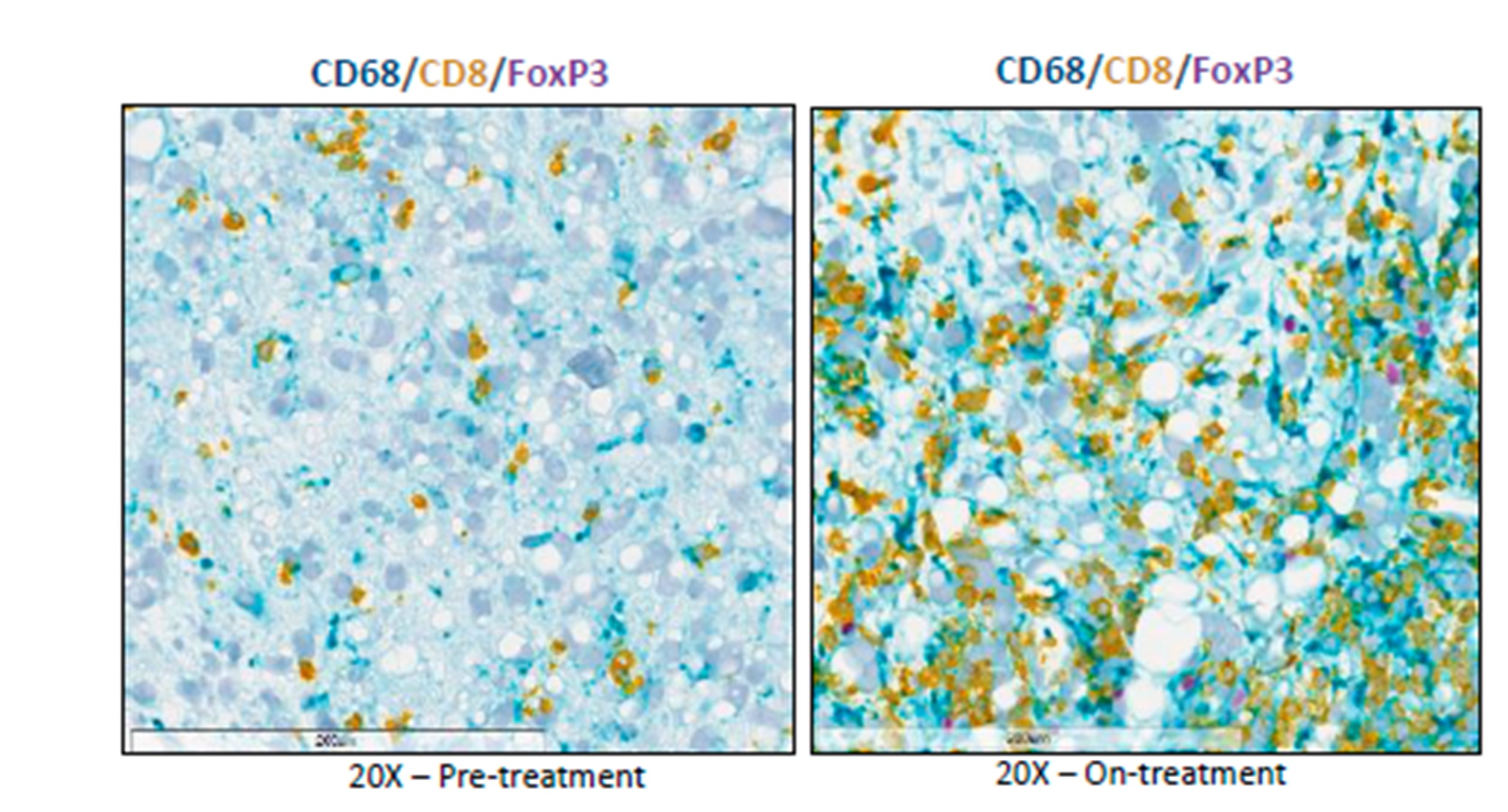 Figura 2. Biòpsies obtingudes abans i després del tractament de pacients de l’assaig. En groc les cèl·lules T infiltrant el tumor.